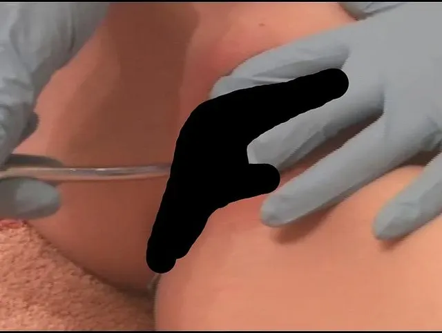 Zeit für den Dilator